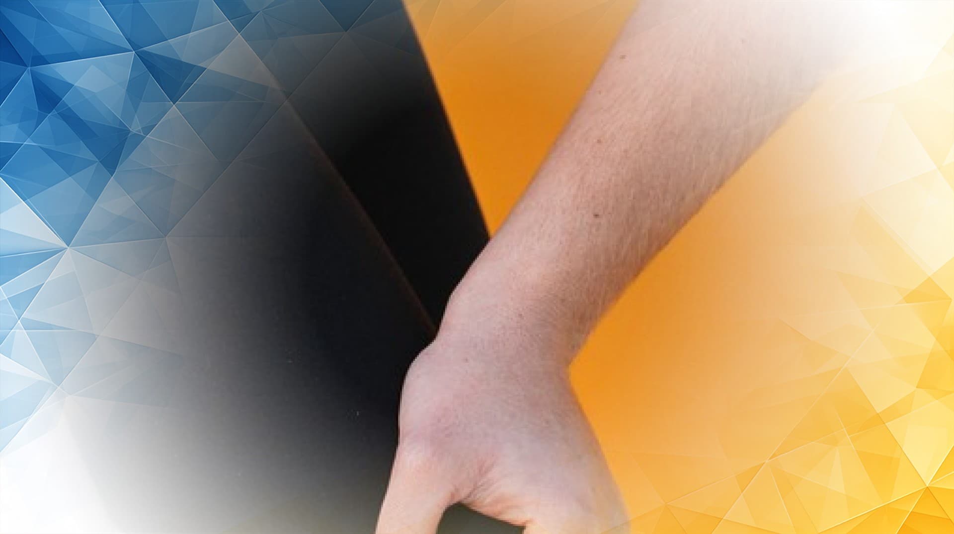 Clinical Insights and Rehabilitation Challenges of Anterior Cruciate Ligament Tears in Eagles