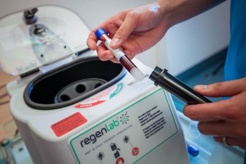 PRP Injections for Hip Arthritis: A Modern Approach to Managing Pain and Enhancing Recovery