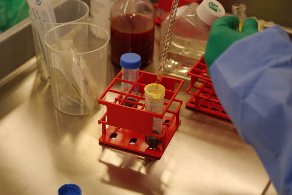 Cartilage cells and biological augmentation being prepared during a procedure at London Cartilage Clinic
