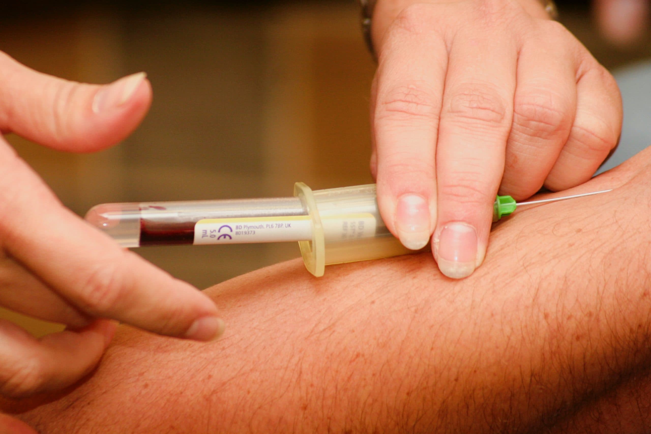PRP syringe needle positioned at lower leg