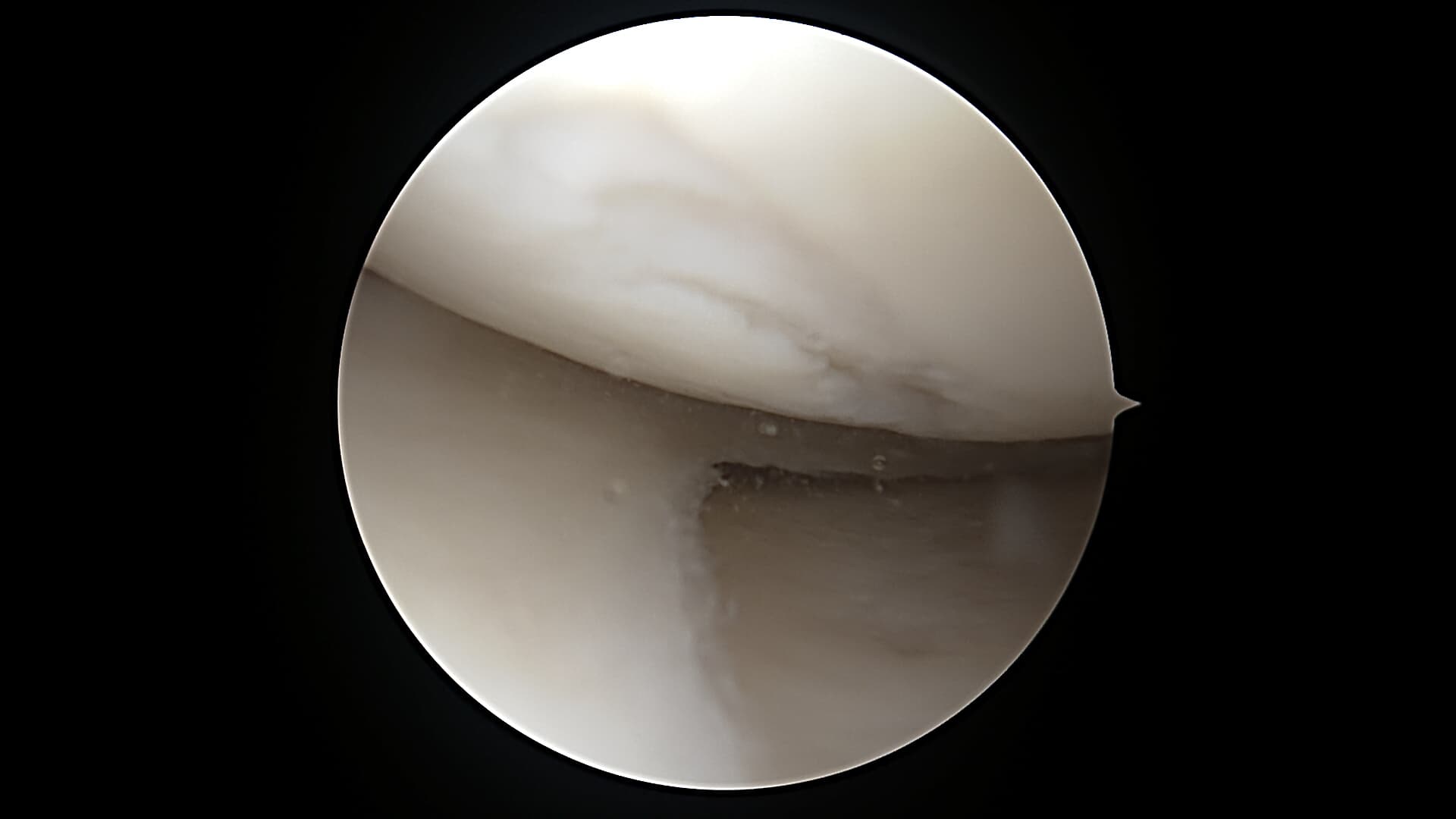 Cartilage Regeneration