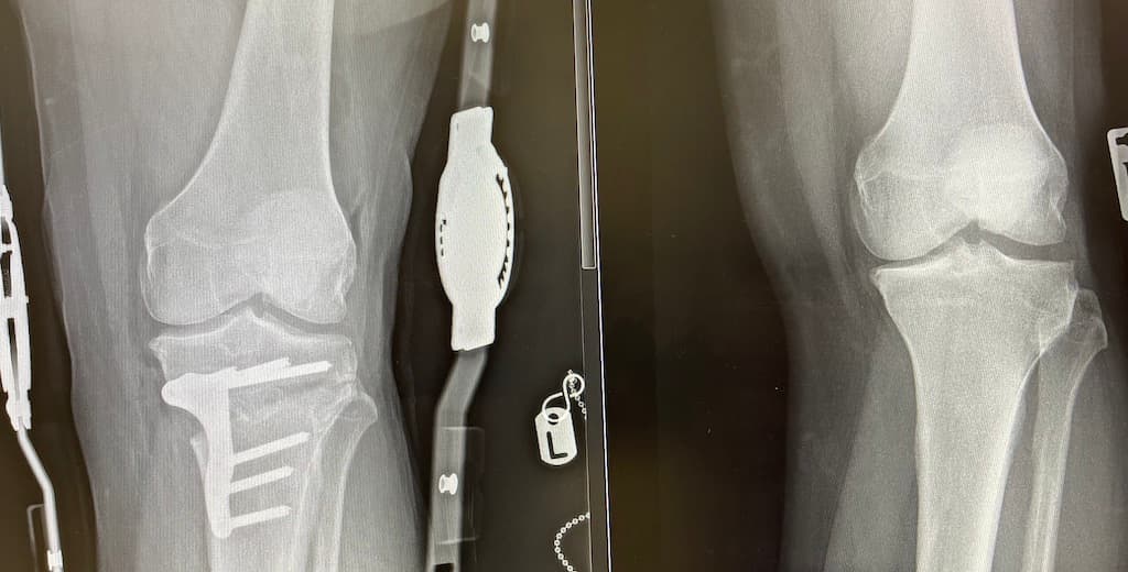 Post-operative knee X-ray with fixation plate