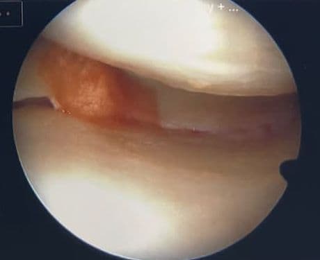 Arthroscopy close-up showing interior of the knee joint