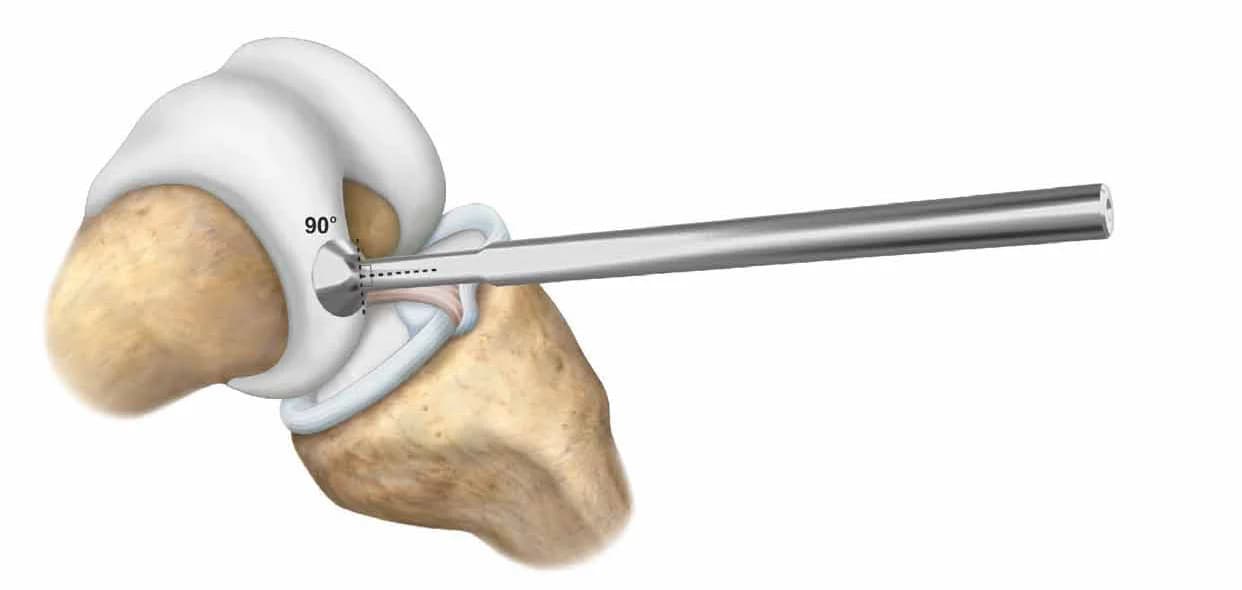 CartiHeal alignment guide positioned over a knee cartilage lesion