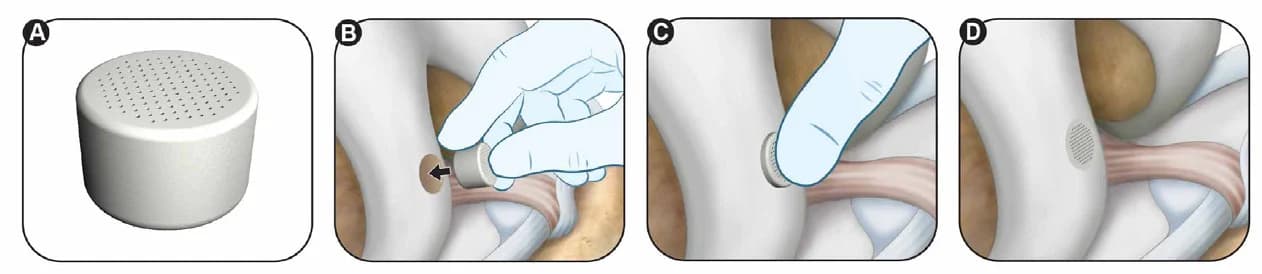 CartiHeal implant being placed during surgery