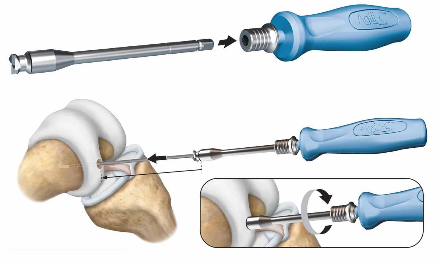 Surgical preparation of the CartiHeal osteochondral implant site