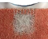 CartiHeal implant during biological remodelling